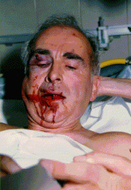 Д-р Форисон след едно от нападенията, когато е бил по-млад.